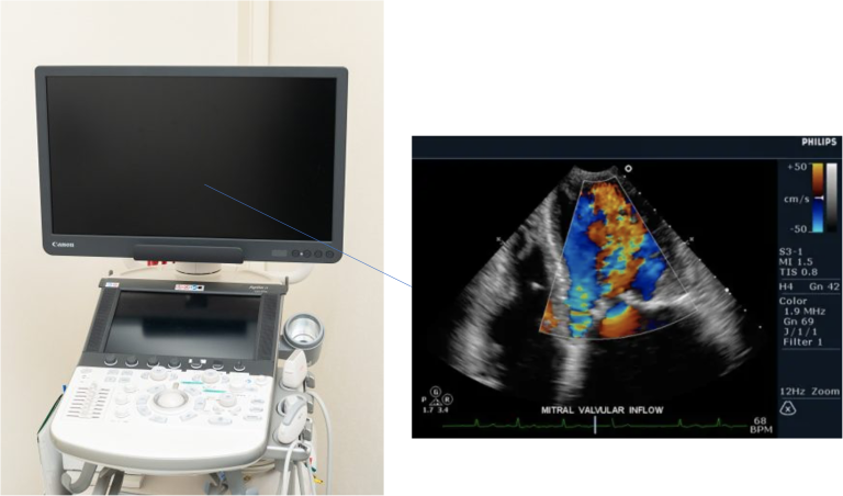 心エコー検査／心臓超音波検査｜石巻市の蛇田さくら内科クリニック